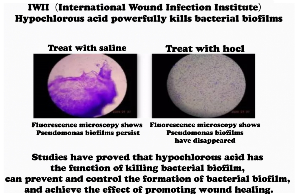 A Comparison between Hypochlorous Acid and Normal Saline Solution